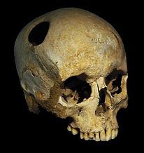 This is an example of prehistoric medical practices found on a human skul, a practice called,Trepanning. This is the only evidence we have without written sources of medical practices; through anthropological human remains.